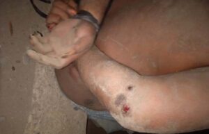 Baru ID Sendiri yang Jadi Tersangka Kasus Pengeroyokan ODGJ di Lembata